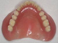 精密義歯